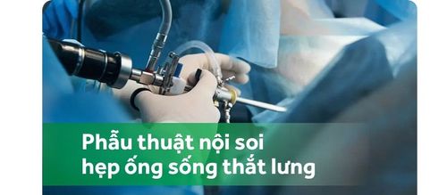 Phẫu thuật nội soi cắt bản sống giải ép trong hẹp ống sống thắt lưng