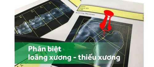 Phân biệt loãng xương với thiếu xương