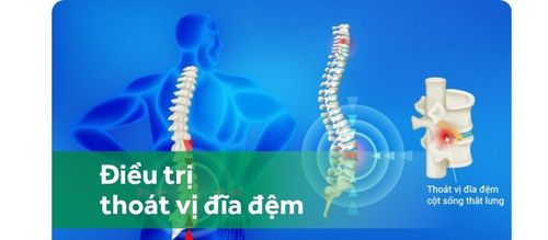Điều trị thoát vị đĩa đệm cột sống thắt lưng