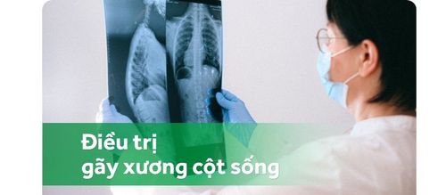 Điều trị gãy xương cột sống mà không cần phẫu thuật