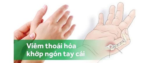 Viêm thoái hóa khớp ngón tay cái: Nguyên nhân, triệu chứng