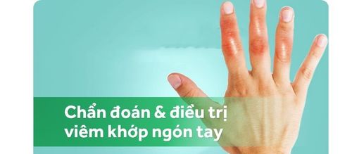 Viêm khớp ngón tay: Chẩn đoán và điều trị