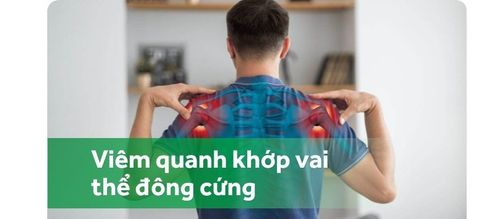 Viêm quanh khớp vai thể đông cứng gây đau nhiều, khó điều trị dứt điểm