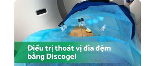 Quy trình điều trị thoát vị đĩa đệm qua da bằng Discogel dưới chụp số hóa xóa nền