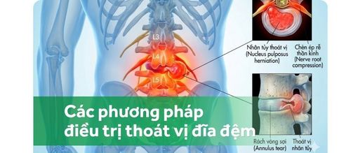 Điều trị thoát vị đĩa đệm: Biện pháp khắc phục và thuốc