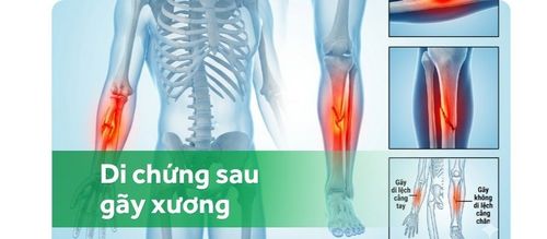 Biến chứng và di chứng thường gặp sau gãy xương