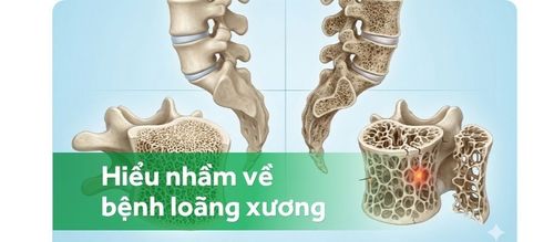Những hiểu nhầm thường gặp về loãng xương