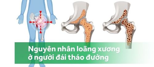 Loãng xương và đái tháo đường