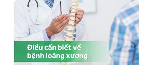 Những điều cần biết về bệnh loãng xương