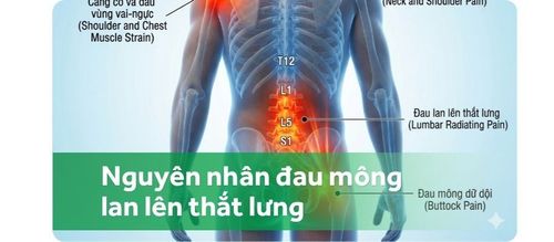 Đau mông lan lên thắt lưng kèm vai gáy là dấu hiệu bệnh gì?