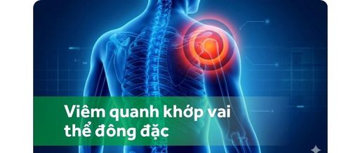 Viêm quanh khớp vai thể đông đặc: Chẩn đoán và điều trị