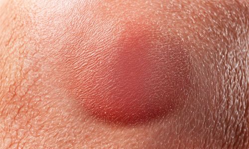 Cách phục hồi da bị dị ứng mỹ phẩm tốt nhất cần biết