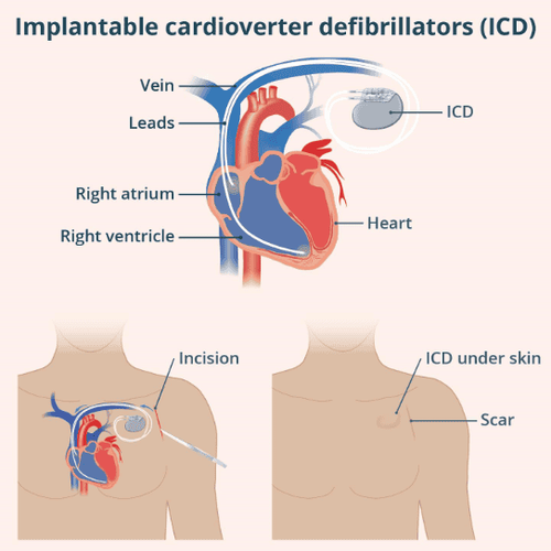 Minh họa đặt máy ICD 