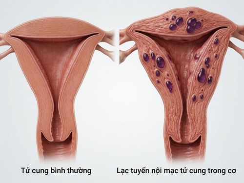 Phẫu thuật cắt tử cung: Khi nào được chỉ định và những điều cần biết