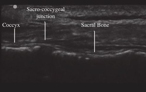 The coccyx is below the sacrum, and is the last portion of the spine