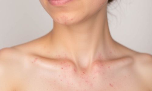 Mụn dị ứng thời tiết và những thông tin cần lưu ý