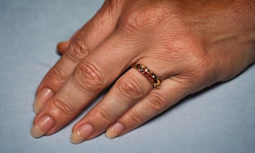 Nổi mề đay do lạnh: Nguyên nhân và triệu chứng