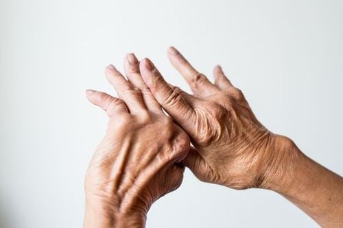Hand deformity in rheumatoid arthritis