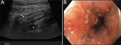 (A) Hình ảnh cắt ngang của bệnh viêm đại tràng Crohn cấp tính ở đại tràng sigma (đầu dò 9 MHz) Phân tầng mờ của thành ruột dày (mũi tên) và tăng sinh xơ mỡ rõ rệt (dấu sao). (B) Hình ảnh nội soi tương ứng của cùng một bệnh nhân trong cùng một tuần