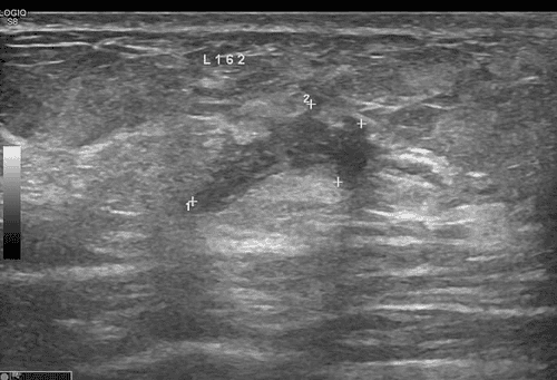 Actual image of the patient's tumor via ultrasound