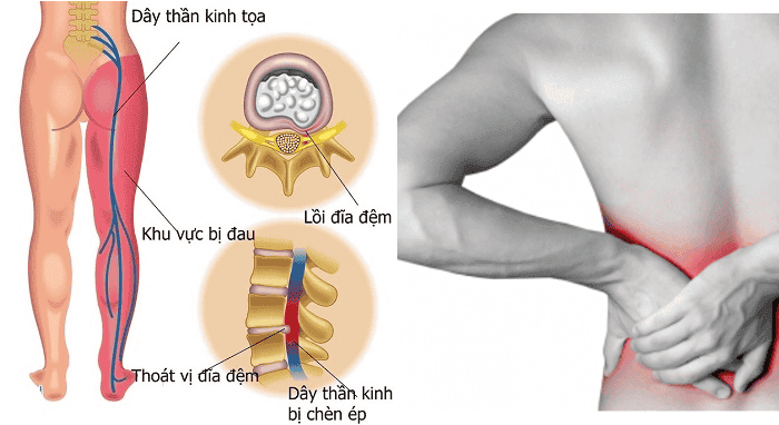 Tình trạng đau nhức vùng lưng là dấu hiệu cảnh báo đĩa đệm đang bị tổn thương nghiêm trọng.