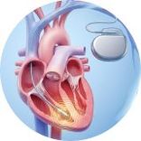 Cấy máy khử rung tim (ICD)