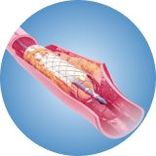 Can thiệp đặt stent mạch vành