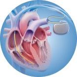 Cấy máy tạo nhịp tim