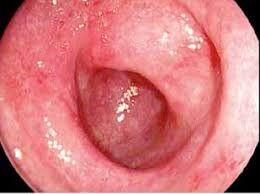 Hình ảnh bệnh viêm ruột trên nội soi